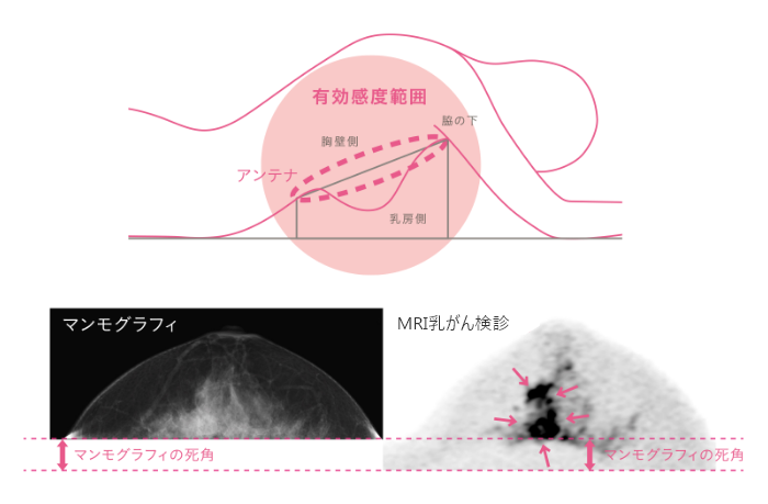 無痛MRI乳がん検診